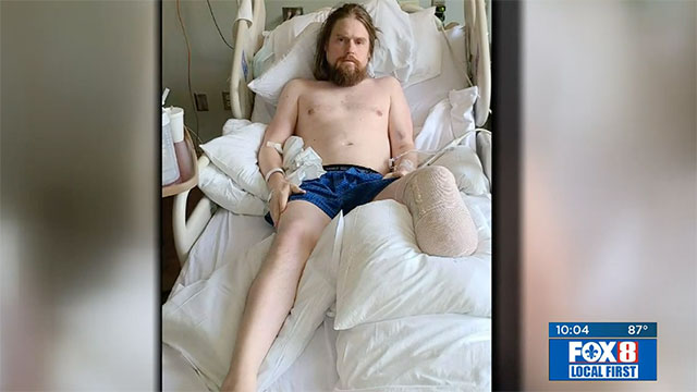 Bryan Thompson lost his leg due to COVID complications
