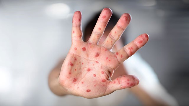 Measles